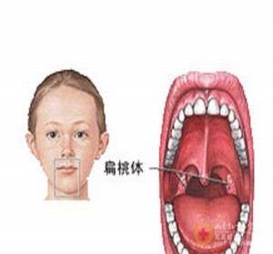 扁桃体发炎的原因